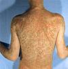 New And Better Treatment For Psoriasis 